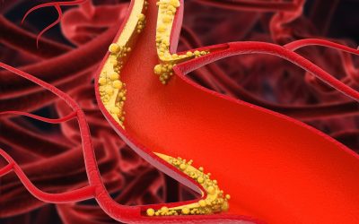 Atherosclerosis: Causes, Symptoms, and Treatment Innovations