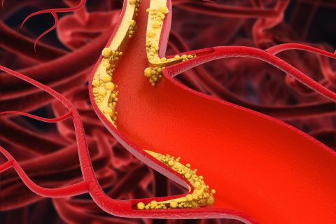 Atherosclerosis: Causes, Symptoms, And Treatment Innovations