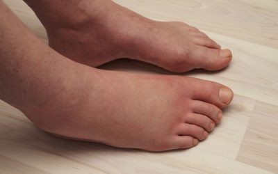 Managing Diabetic Swollen Feet – Tips for Comfort and Relief