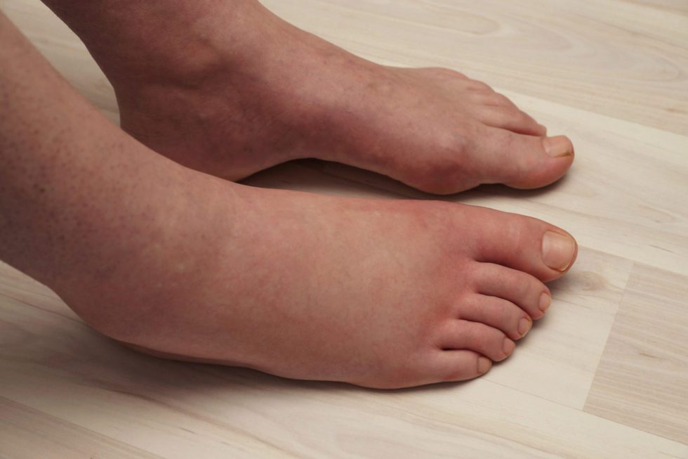 managing-diabetic-swollen-feet-tips-for-comfort-and-relief